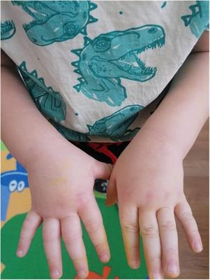 Case Report: Early presentation of hereditary angioedema symptoms in a 2-year-old boy